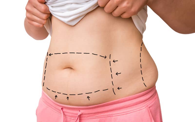 Non Invasive Body Fat Reductions