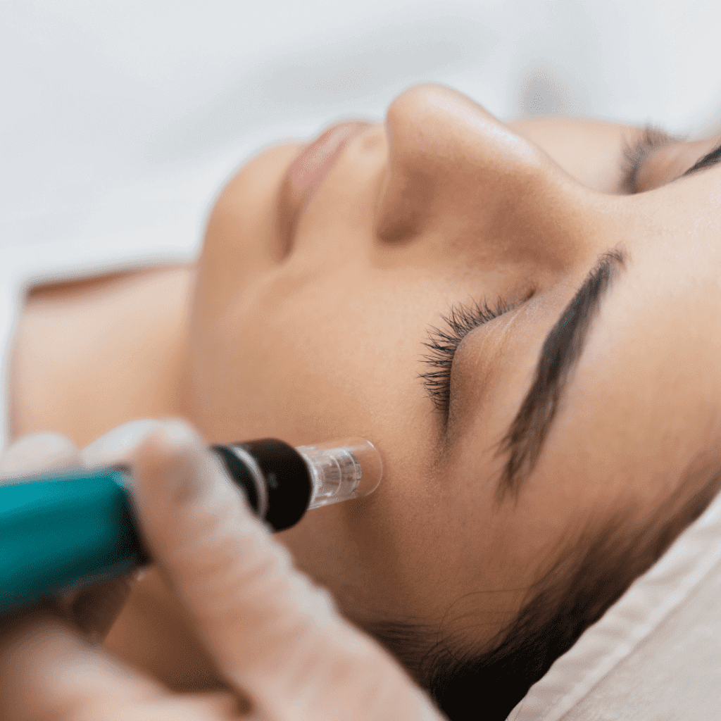 Microneedling: What You Need to Know