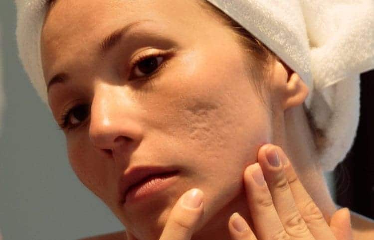 How to Reduce Acne Scarring for Smooth, Even Skin