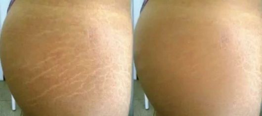 HIFU-STRETCH-MARKS-BEFORE-AFTER-PHOTO-2.jpg