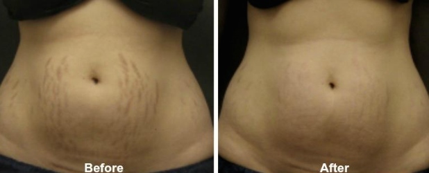 HIFU-STRETCH-MARKS-BEFORE-AFTER-PHOTO.jpg