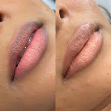 lip-neutrilisation-4.jpg